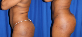 liposuction-p11-2