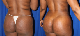 liposuction-p11-3