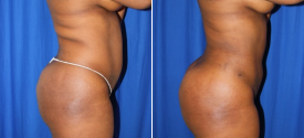 liposuction-p11-4