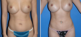 liposuction-p2-1