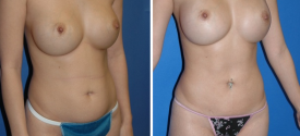 liposuction-p2-2