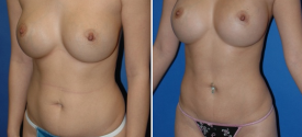 liposuction-p2-3
