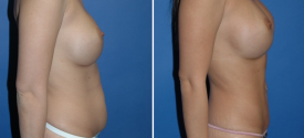 liposuction-p2-4