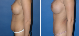 liposuction-p2-5