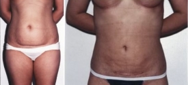 liposuction-p3