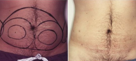 liposuction-p4-1