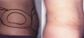 liposuction-p4-2