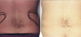 liposuction-p4-3