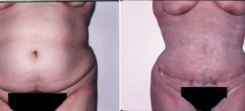liposuction-p5-1
