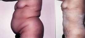 liposuction-p5-2