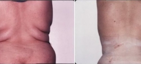 liposuction-p5-3