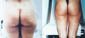 liposuction-p6