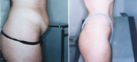 liposuction-p7