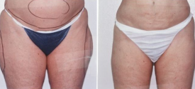 liposuction-p8-1