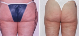 liposuction-p8-2
