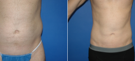 liposuction-p9-1