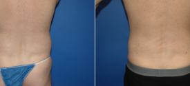liposuction-p9-2