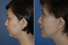 07_necklift