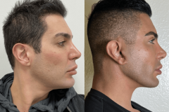 08_necklift