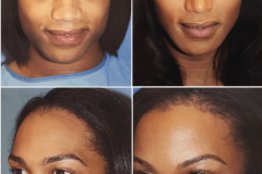01_rhinoplasty