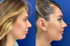 02_rhinoplasty