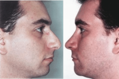 03_rhinoplasty