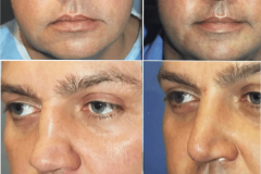 06_rhinoplasty