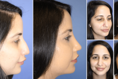 07_rhinoplasty