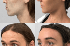 08_rhinoplasty