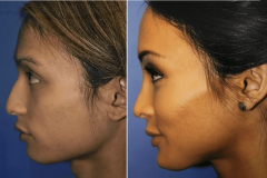 09_rhinoplasty