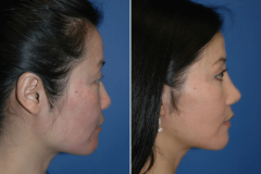 10_rhinoplasty