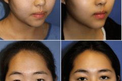 11_rhinoplasty