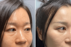 12_rhinoplasty