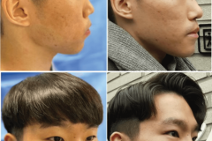 13_rhinoplasty