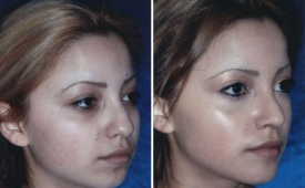 rhinoplasty-p1-2