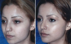 rhinoplasty-p1-3