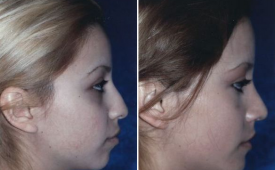 rhinoplasty-p1-4