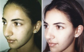 rhinoplasty-p2-1