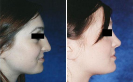 rhinoplasty-p3-2