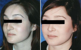 rhinoplasty-p3-3