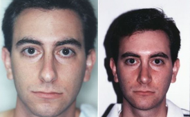 rhinoplasty-p4-1
