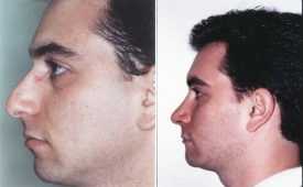 rhinoplasty-p4-2