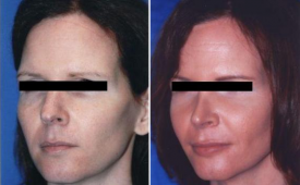rhinoplasty-p5-1