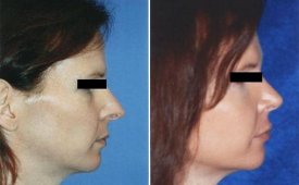 rhinoplasty-p5-2