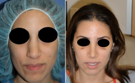 rhinoplasty-p6