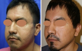 silicone-removal1-2