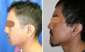 silicone-removal1-3