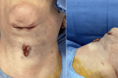 01_thyroid_cartilage_shave