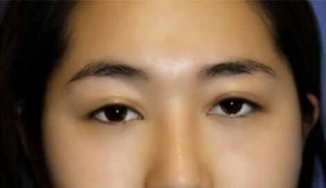 Case--5757 | After Blepharoplasty