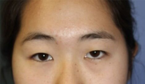 Case--5757 | Before Blepharoplasty
